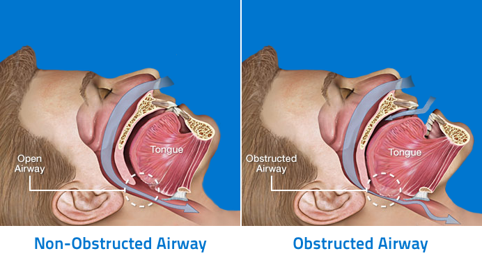 Anatomy-of-Obstructive-Sleep-Apnea