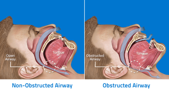 Anatomy-of-Obstructive-Sleep-Apnea